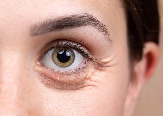 Pattes d’oies : comment éviter les rides sous les yeux ?