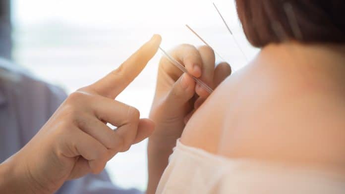 Une personne reçoit un traitement d'acupuncture sur son épaule, représenté par de fines aiguilles insérées dans la peau et la main d'un praticien au premier plan, montrant comment l'acupuncture peut apporter un soulagement même pendant la grossesse.